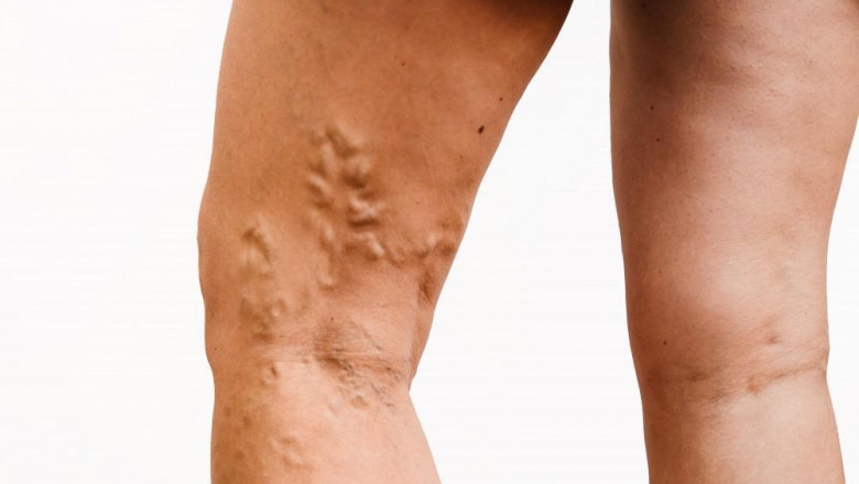 Varicose Veins - What More Do You Need To Know?
