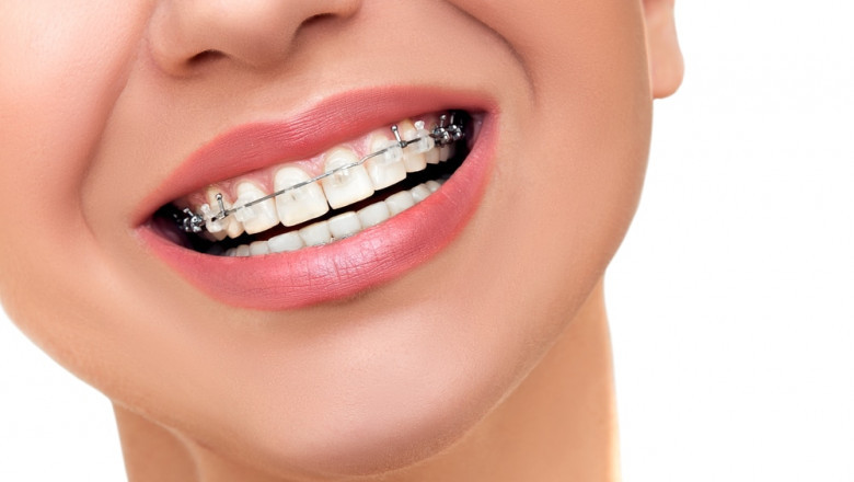 What Is the Fastest Method To Get Straight Teeth?