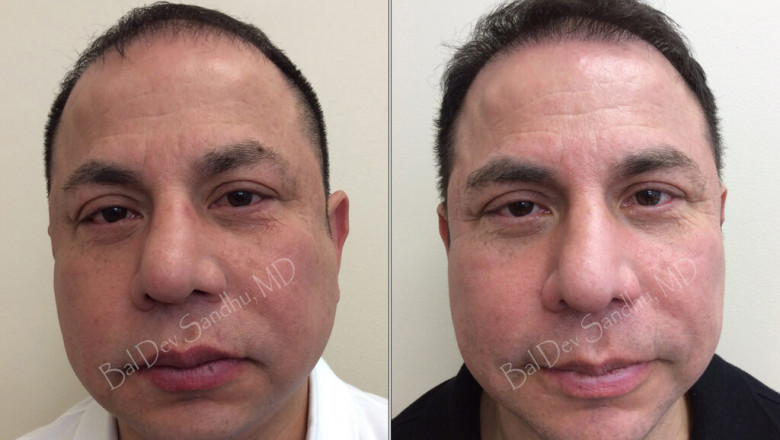 Find The Best Hair Transplant Doctor in New Jersey Online