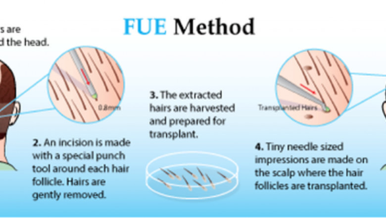 Why Follicular Unit Extraction [FUE] is Most Preferred Hair Transplant Technique – and Its Multifaceted Utilities