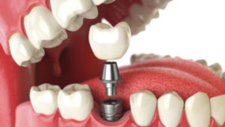 Implantes dentales