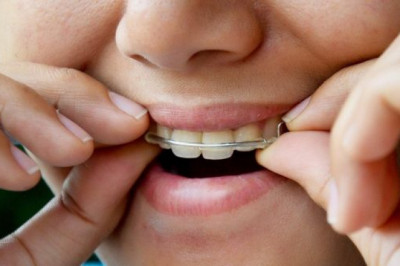 What Is A Root Canal Procedure, And Who Should Perform It?