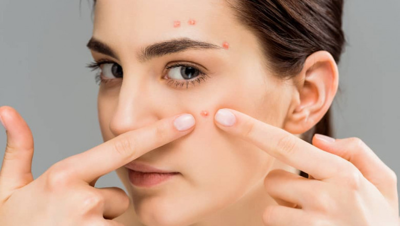 Does acupuncture really work for acne?