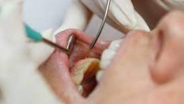What is a Gingivectomy?
