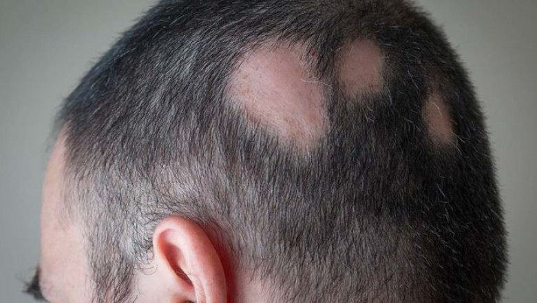 What is alopecia areata?
