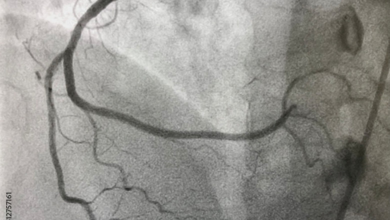 Angiography Catheters Market to Witness Significant Growth by 2020-2026 with- Medtronic, Boston Scientific Corporation, Terumo Medical Corporation