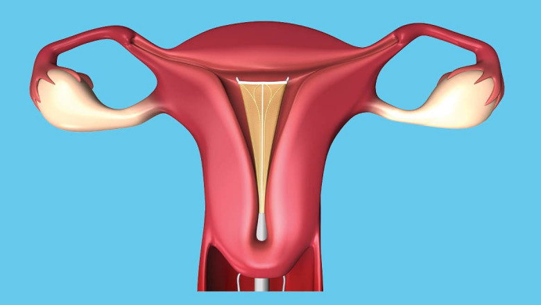 Endometrial Ablation Involves Removing Or Destroying The Endometrium Non-Invasively