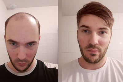 Breaking Down Common Myths Behind Nonsurgical Hair Loss Solutions