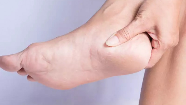 Causes and Remedies for Cracked Feet in Monsoon