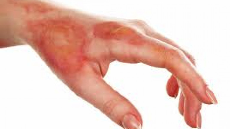 An Analysis Of The Global Burn Care Market, Including Trends, Shares, Sizes, Growth, Opportunities, And Forecasts For 2019-2026