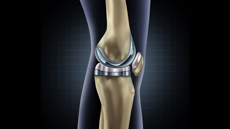 Impact of COVID-19 on Knee Implants Market