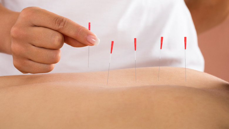 Benefits and Importance of Dry Needling in Physiotherapy