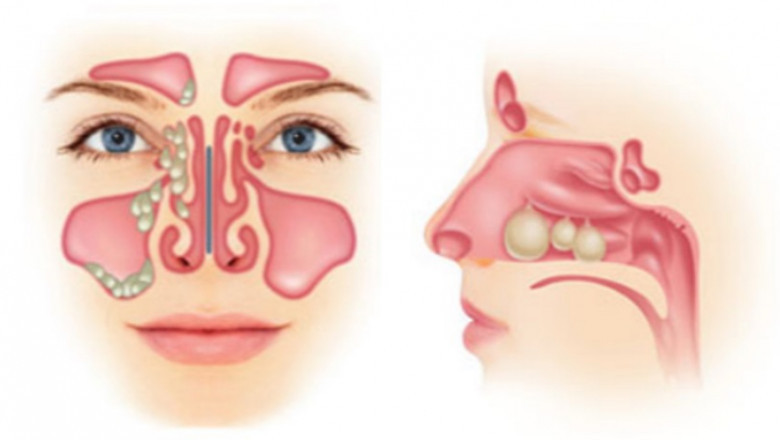 Market Trends, Share, Size, Growth, Opportunity and Forecast for Nasal Polyps Treatment Market 2022-2028