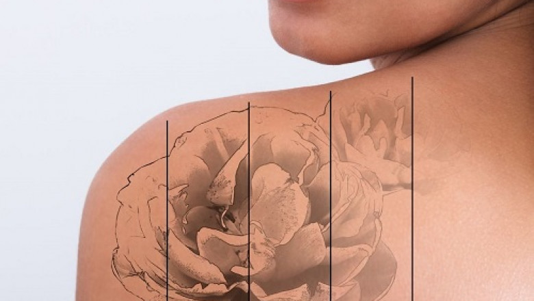 Tattoo Removal Lasers: The Most Effective Ways to Erase Your Ink