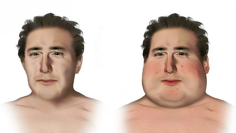 How do doctors diagnose Cushings syndrome?