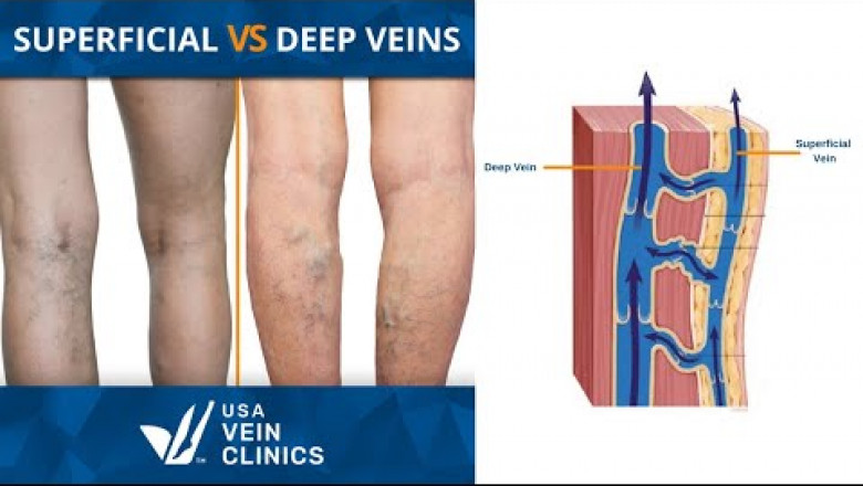 Are All Varicose Veins Visible?
