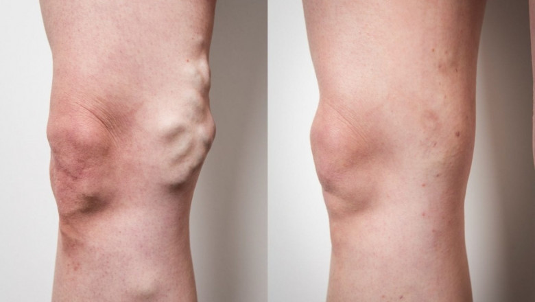 How Much Is the Treatment for Varicose Veins?