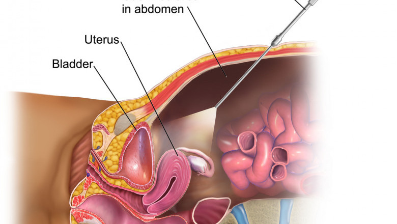 Metabolic Surgery for Diabetes in Indore - Indore Laparoscopy Center