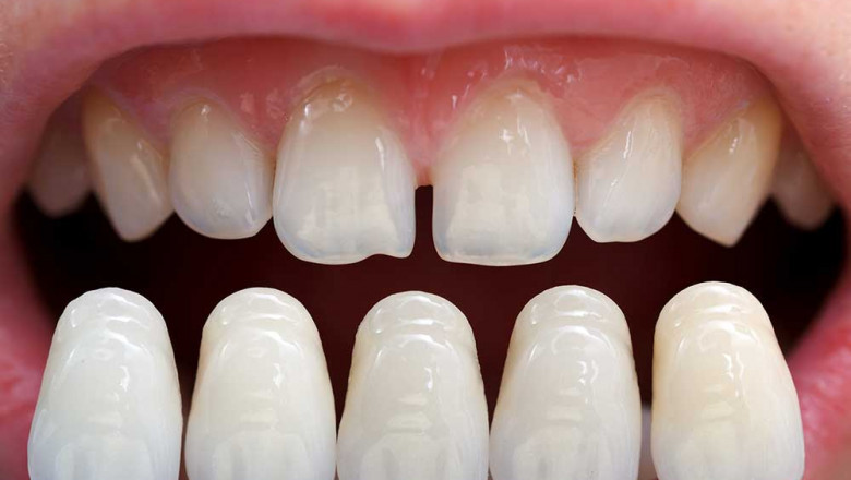 What Are The Pros And Cons Of Teeth Veneers?