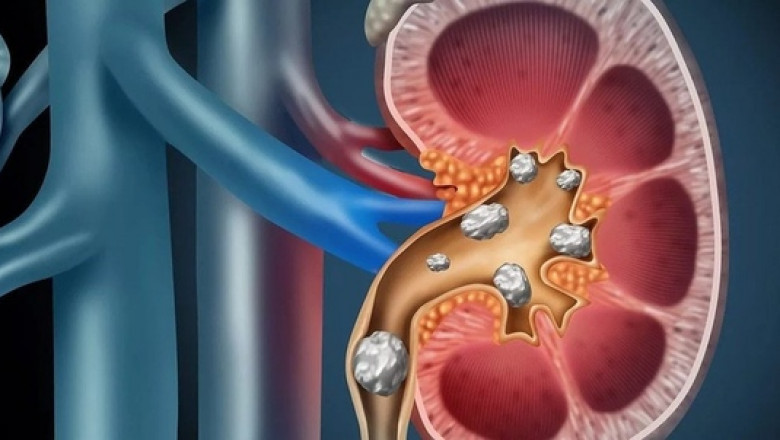 How The Kidney Stone Management Devices Extracts Calcium Oxalate From The Kidney