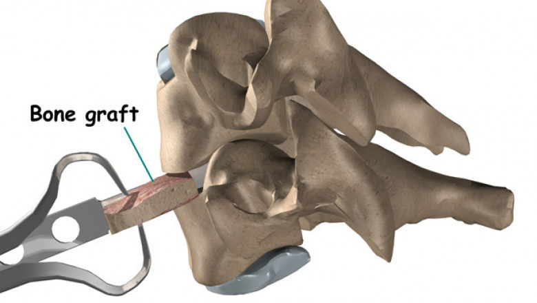 Bone Grafts And Substitutes Are Surgical Techniques Used To Replace Lost Bone