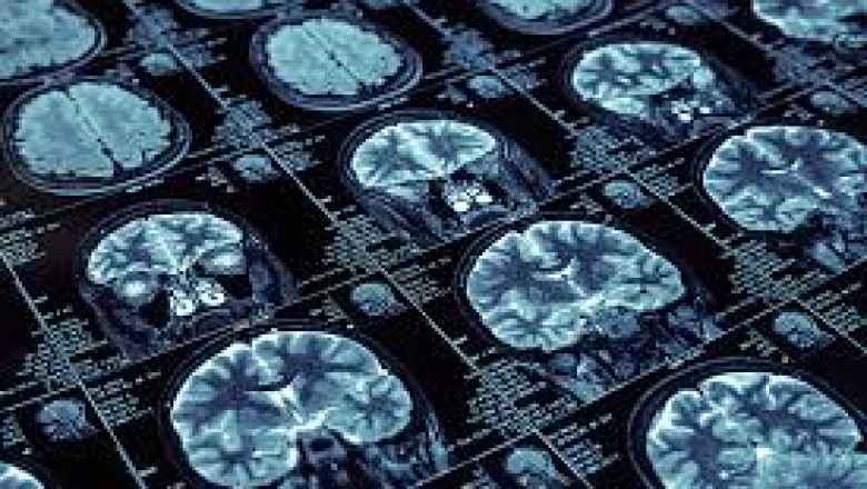 Understanding The Difference Between Neurosurgery &amp; Neurology