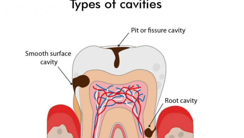 Types of dental caries