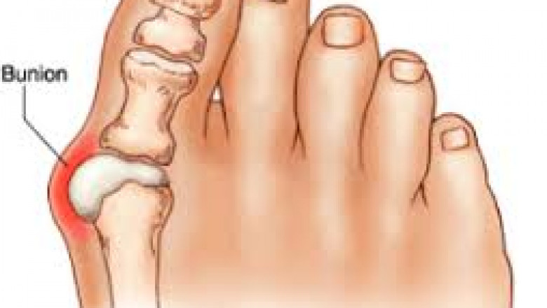 What is Bunion? Symptoms, Causes &amp; Prevention