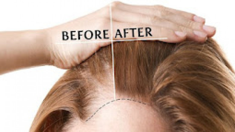 How Can Hair Loss be Treated, and What are Some Common Causes?
