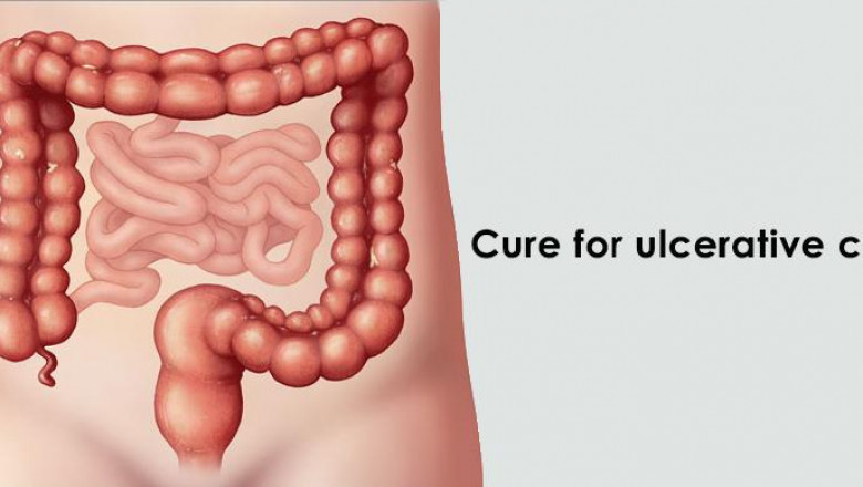 Although China Ulcerative Colitis Can Occur At Any Age, It Most Frequently Affects Adults