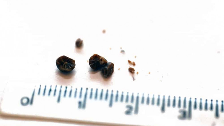 How Do You Treat The Different Sizes Of Kidney Stones Differently?