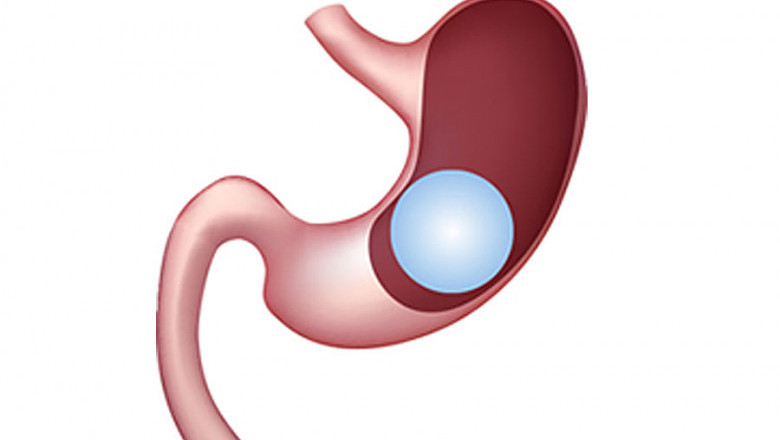 Intra Gastric Balloon - Laser Bariatric Surgery | Dr. Achal Agarwal