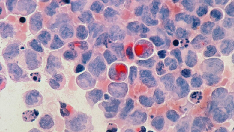 Rising Investments in the Creation Of Cutting-Edge Technology and an Increase in the Number of New Markets Will Present Favourable Prospects for the Expansion of the Solid Tumors Treatment Market