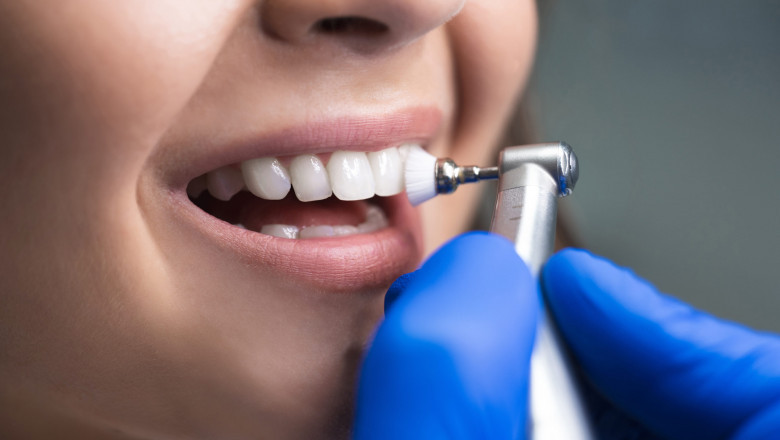 What are dental bridges?