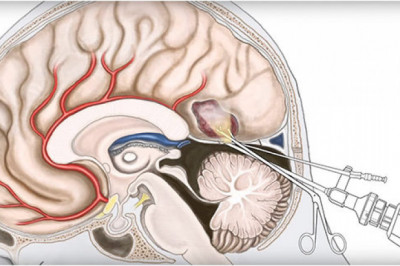 Neuroendoscopy Market Size, Growth & Global Forecast Report to 2028