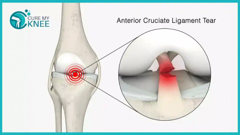 ACL Surgery Cost in India