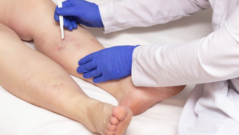 How Can You Limit The Effect Of Varicose Veins?