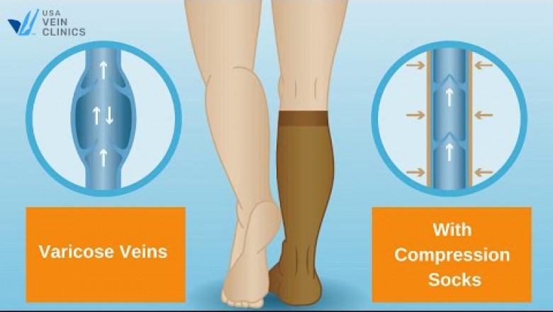 The Benefits of Vein Compression Socks