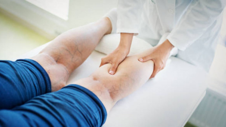 The Global Varicose Vein Treatment Market will be Dominated by User Friendly Devices with a Greater Emphasis on Safety and Efficiency