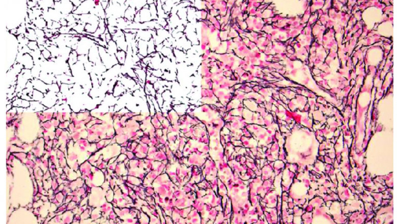 Know the Goal of Myelofibrosis Treatment