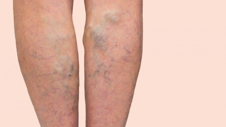 When Should You See a Vascular Doctor?