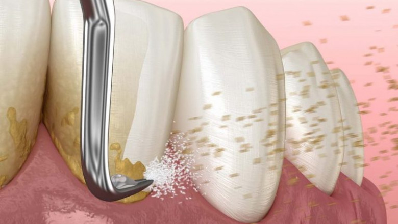 Why Are Dental Fillings So Useful For Dentistry?