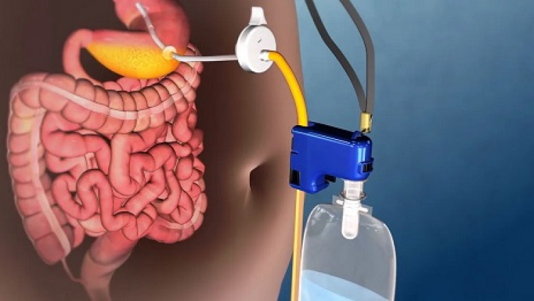 Forecasts of the Global Bariatric Surgery Devices Market: 2022-2030: Trends, Size, Growth, Opportunities and Forecasts