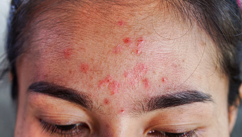 What is erysipelas?
