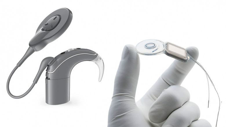 One of the Major Factors Driving the Growth of the Cochlear Implants Market Is the Increasing Prevalence of Hearing Impairment Among the Global Population
