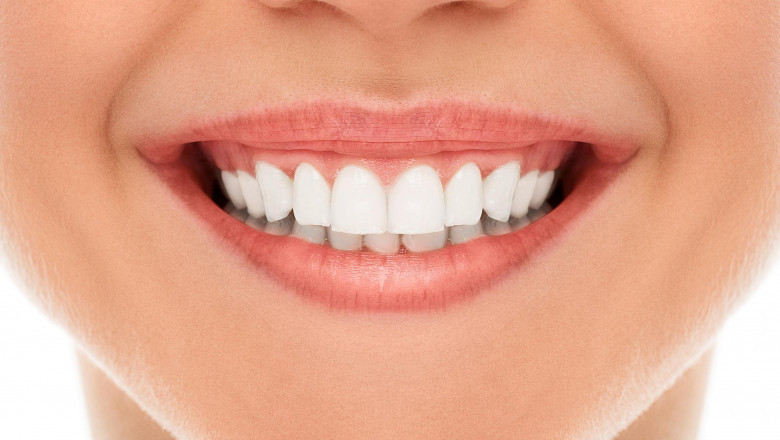 Dental veneers in dubai