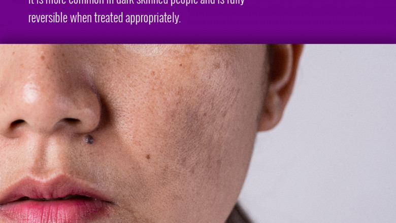 Are you tired of your skin problems? Consult with the Best Dermatologists in Bangalore
