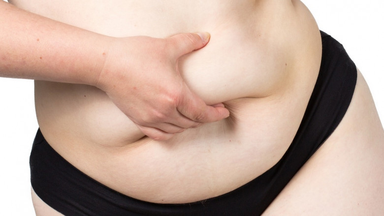 Frequently asked questions about liposuction