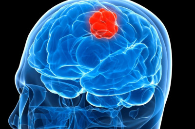 Glioblastoma Multiforme Treatment Market Deep Analysis, Forecast period 2022-2027