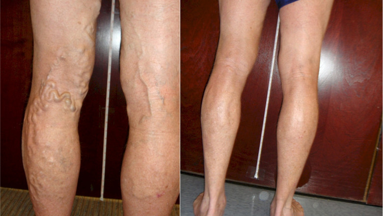 How Much Varicose Vein Treatment Costs Without Any Insurance?